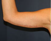 Feel Beautiful - Arm Reduction 205 - After Photo